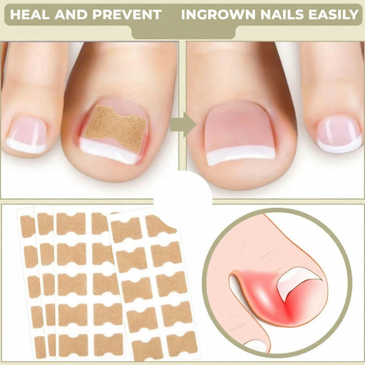 Toenail Corrector Patches Ingrown Nail Treatment