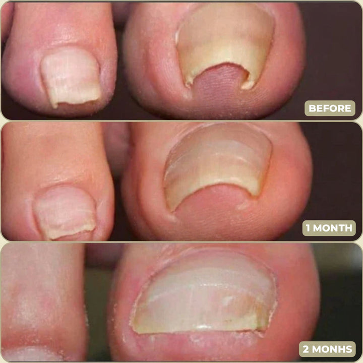 Toenail Corrector Patches Ingrown Nail Treatment